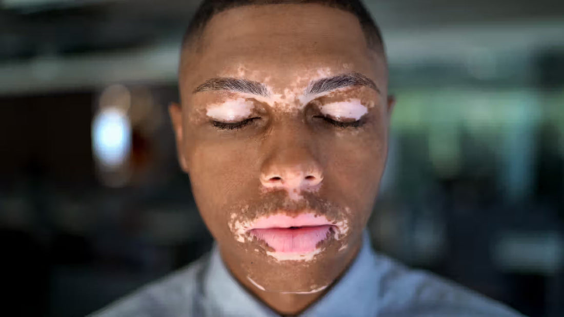 My Story with Vitiligo - Hoping to Inspire